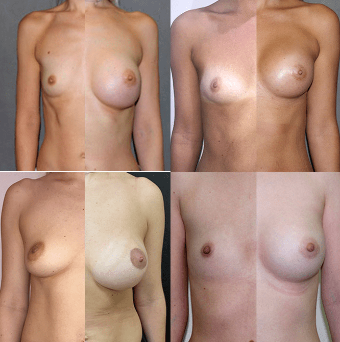 Foto prima e dopo la mammoplastica al seno