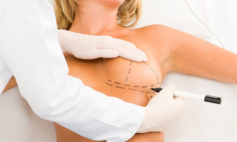 Mammoplastica marcatura al seno