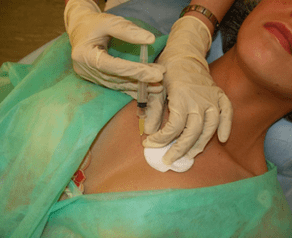 Introduzione del meso-cocktail nel tessuto mammario - un'alternativa alle iniezioni di acido ialuronico