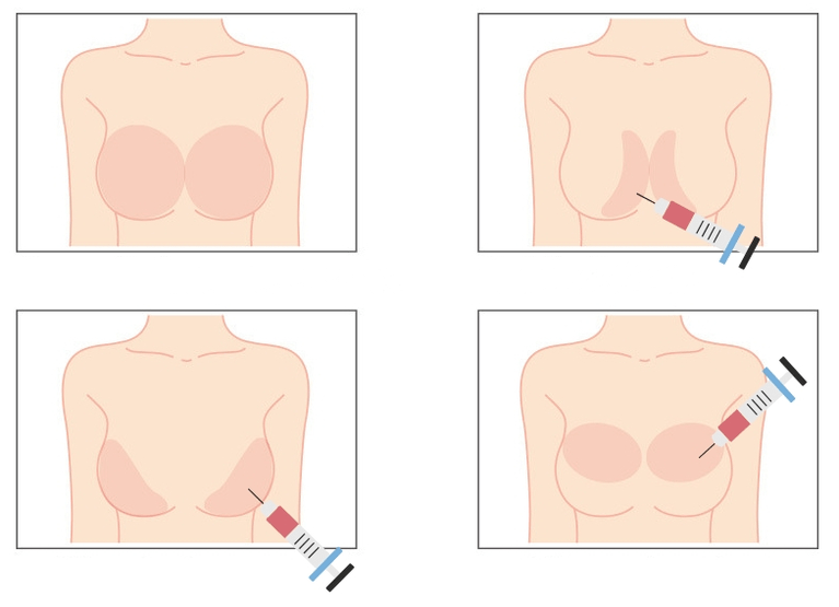 Luoghi per l'iniezione di acido ialuronico nel seno