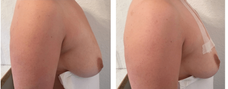 Prima e dopo il sollevamento del seno con filo