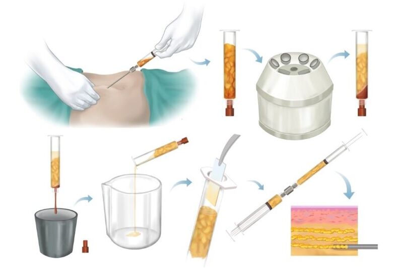 Rimozione del grasso dalle aree problematiche, lavorazione e iniezione nel tessuto mammario